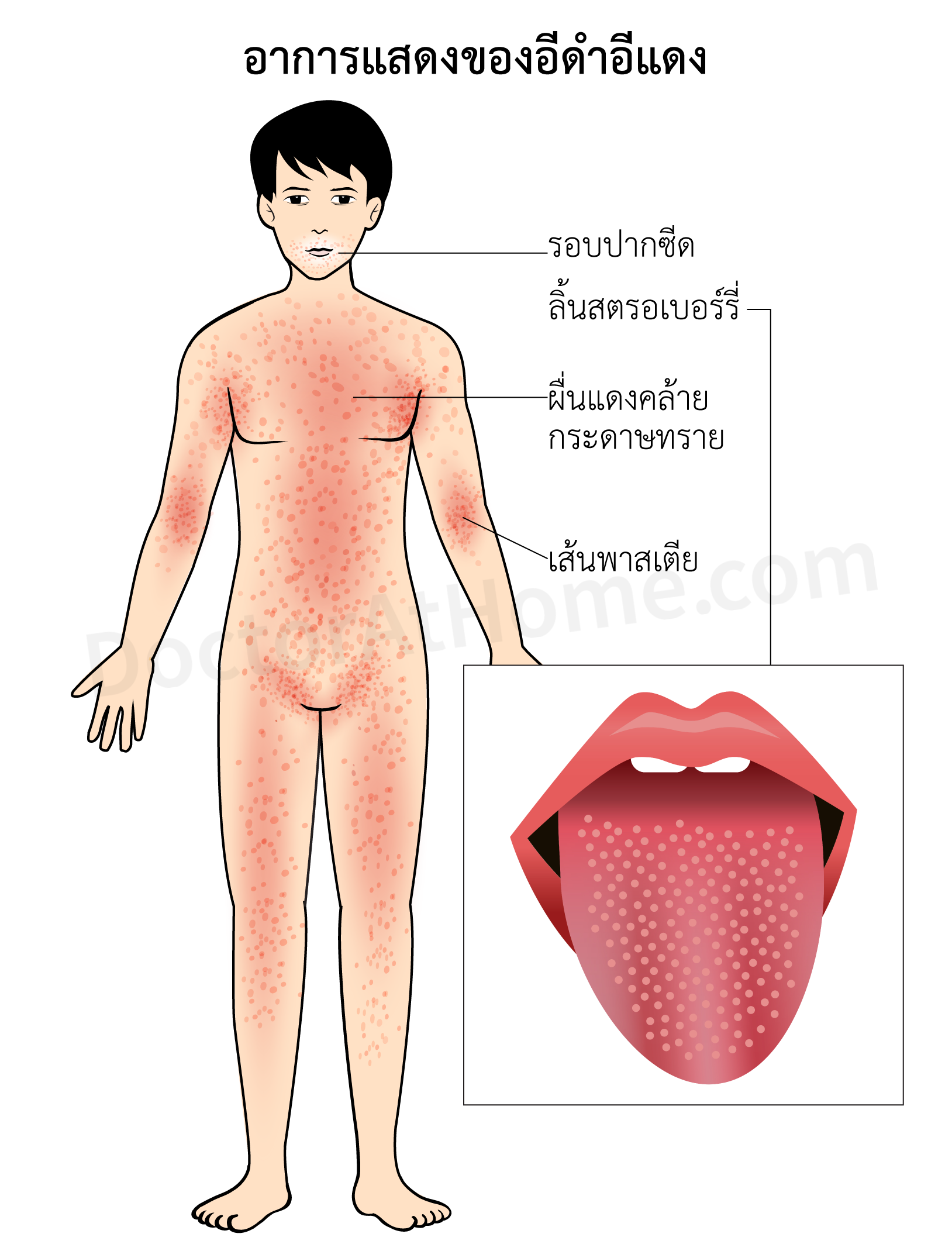 อาการแสดงของอีดำอีแดง